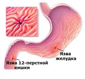 Язва 12 Перстной Кишки Фото